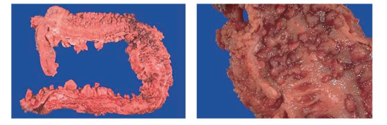 【図】潰瘍性大腸炎